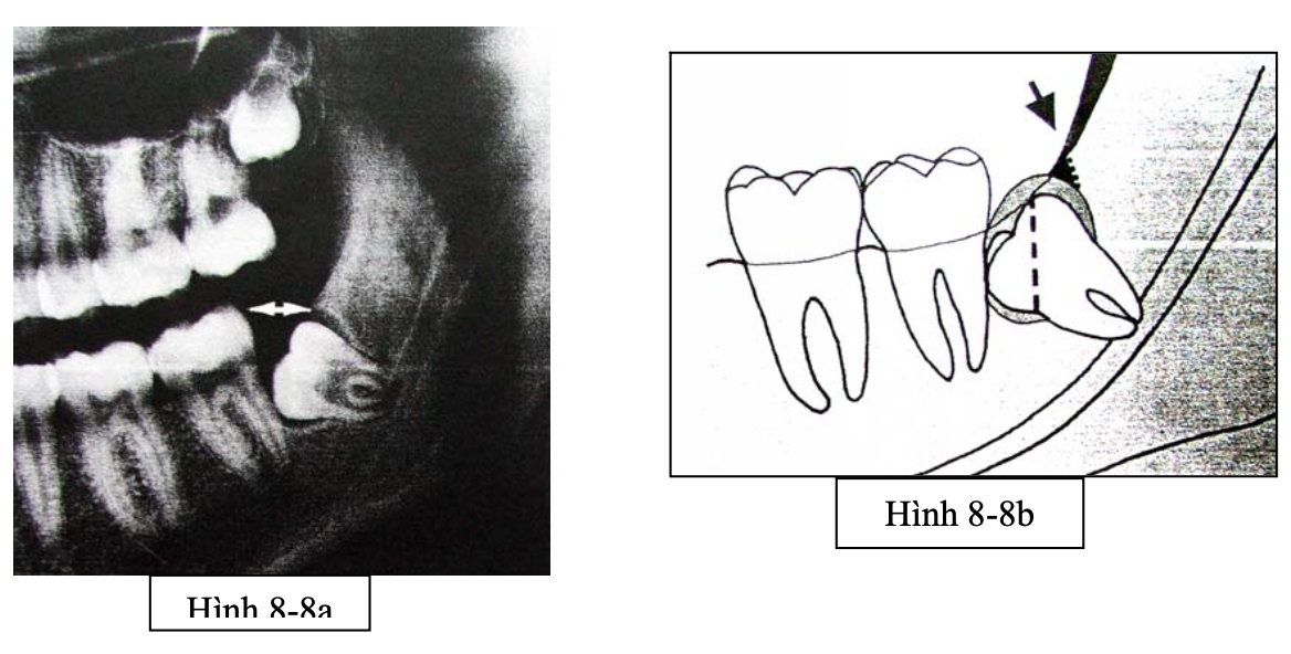 Tiểu phẫu R8 nghiêng gần
